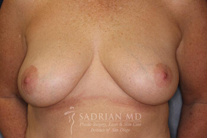Breast Fat Transfer Before & After Image
