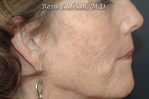 Fractional Resurfacing Before & After Image