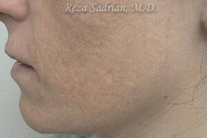 Micro Laser Peel Before & After Image